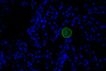 toxoplasma brain cyst